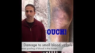 Hematoma leg bruising and swelling [upl. by Ellevel725]