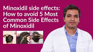 Minoxidil side effects How to avoid Minoxidil side effects  5 Common Side Effects of Minoxidil [upl. by Burack]