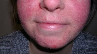 How to Treat Facial Eczema DermTVcom Epi 479 [upl. by Zanahs]