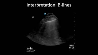 Lung Ultrasound Common Pitfalls [upl. by Armond]