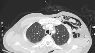 Subcutaneous Emphysema CT JETem 2018 [upl. by Buschi]