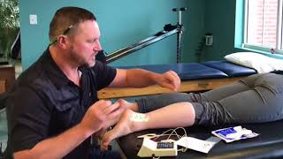 Iontophoresis in Physical Therapy [upl. by Hukill481]