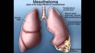 About Stage 4 Pleural Mesothelioma [upl. by Norrehc]