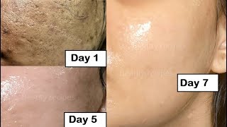 Skin Repair  Close Large OPEN PORES in 1 week Remove Dark Spots Anti Aging [upl. by Corrie]