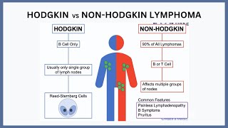 Hodgkin vs NonHodgkin Lymphoma Explained [upl. by Fritts]