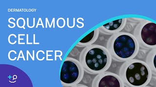 Squamous Cell Cancer Dermatology [upl. by Twitt]