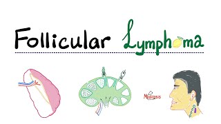 Hodgkins vs Non Hodgkins Lymphoma  Pathology🩺 [upl. by Tram]