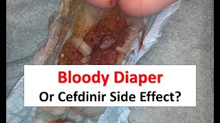 Bloody Diaper or Cefdinir Side Effect [upl. by Odnomor221]