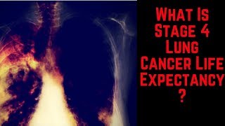 What Is Stage 4 Lung Cancer Life Expectancy [upl. by Bunnie]