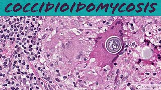 Coccidioidomycosis Coccidioides 5Minute Pathology Pearls [upl. by Hennie]