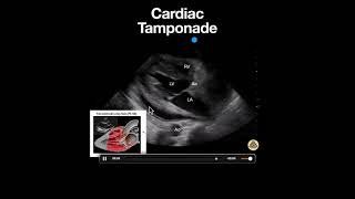 Cardiac Tamponade PSLA [upl. by Tillfourd951]