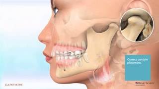 Carriere® Motion™ Appliance for Class II Patient Education Animation 2 [upl. by Cindy]