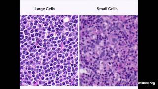 Signs and symptoms of lymphoma  Mayo Clinic [upl. by Ecnedac]