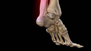 Achilles Tendon Rupture  Complete Anatomy [upl. by Noit811]