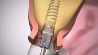 Dental Implants Procedure  Simplified [upl. by Mcallister]