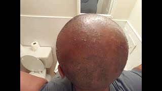 How To Cure Scalp Inflammation Bumps and Blisters  CCCA AlopeciaFolliculitis [upl. by Lilli]