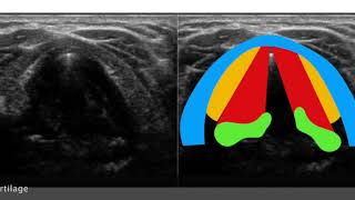 Neck Larynx Vocal cord paralysis [upl. by Allerus]