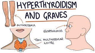 Radioactive Iodine RAI therapy to treat hyperthyroidism [upl. by Ettigirb]