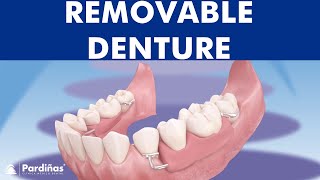 Removable partial denture © [upl. by Tybie528]