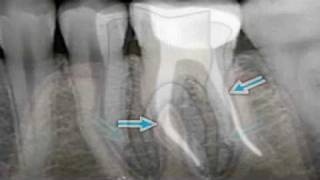 What is Endodontics [upl. by Aivyls]