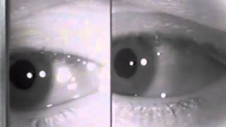 Eye Conditions Nystagmus [upl. by Er]