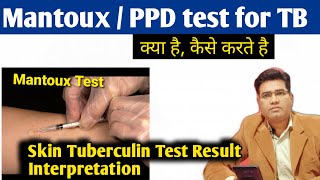 What is Mantoux Test for TB  Procedure and Interpretation Tuberculin Test Result  PPD Test [upl. by Aivirt]