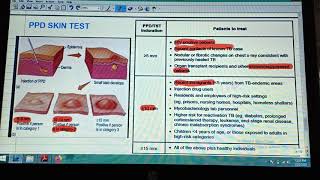 PPD SKIN test or Mantoux Test interpretation [upl. by Demaggio914]