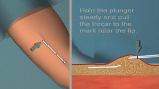 Jadelle insertion and removal Tutorial [upl. by Schreck]