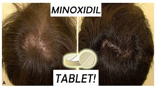 Minoxidil Tablets replacement for 5 MinoxPros amp Cons Episode 1 [upl. by Giselle]