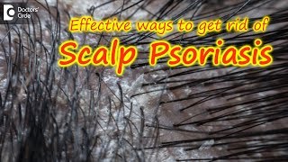 Scalp psoriasisSymptom Cause Treatment  Safe ways to Wash Hair Dr Rasya Dixit Doctors Circle [upl. by Irvin59]