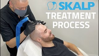 Skalp® Scalp Micropigmentation Treatment Process [upl. by Sivehc]