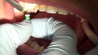 root canal treatment part 1 [upl. by Hanikas]