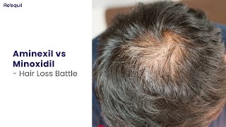 Aminexil vs Minoxidil  Hairloss Battle [upl. by Adnamal]