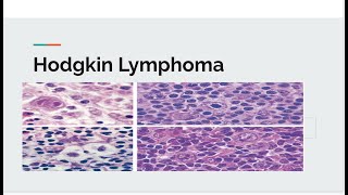 Hodgkin lymphoma [upl. by Strenta]