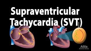 Supraventricular Tachycardia SVT PSVT Animation [upl. by Norvin507]