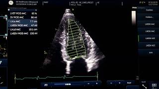 Ejection fraction measurement [upl. by Sahpec]