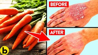 14 Foods That Are Great For Fighting Your Psoriasis [upl. by Andrel]