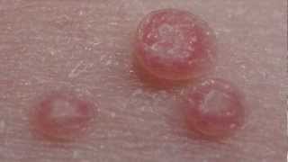 How to treat Molluscum Contagiosum [upl. by Chapland]