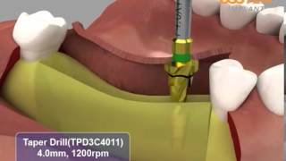 HIOSSEN OSSTEM ETIII System surgical procedures [upl. by Kcirdneked]