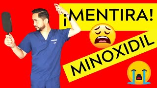 🤯🟢🟥 Realmente FUNCIONA el MINOXIDIL para el CABELLO ¿Si o No [upl. by Graybill]