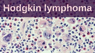 Hodgkin Lymphoma  Pathology mini tutorial [upl. by Fayette]