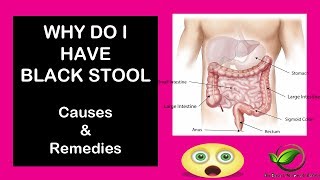 Why Do you have Black Stool  Causes amp Remedies for black stool [upl. by Kcirdek]