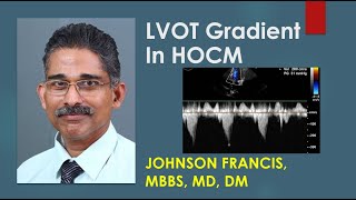 LVOT Gradient In HOCM [upl. by Calisa633]