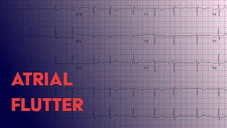 Atrial Flutter  EKG ECG Interpretation [upl. by Yeblehs]