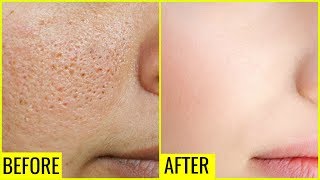 How to Get Rid of Large OPEN PORES Permanently  Anaysa [upl. by Airotcivairam]