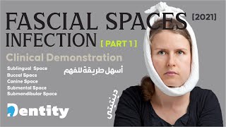 شرح مبسط  Fascial Spaces Infection  PART 12 [upl. by Primalia]