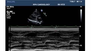 LVOT Obstruction [upl. by Branca]