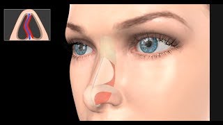 Deviated Septum Surgery Septoplasty [upl. by Magna829]