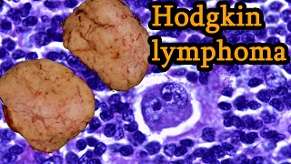 Hodgkins Lymphoma Symptoms Medical Oncologist Explains [upl. by Anir]