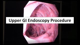 Upper GI Endoscopy Procedure in the ED [upl. by Aeli]